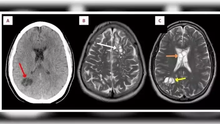 Homem tem enxaqueca agonizante após comer bacon mal cozido e é diagnosticado com larvas no cérebro